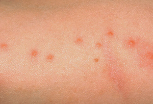 Bed Bug Skin welts